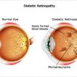 Diabetic eye disease
